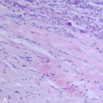 Eosinophilic myocarditis HE stain.jpg