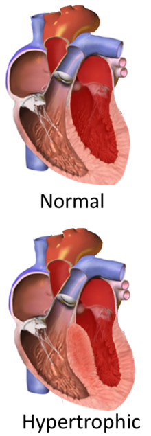 Hypertrophic obstructive cardiomyopathy.png