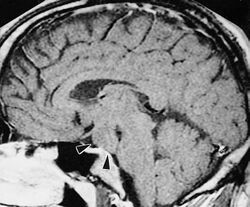 Hypothalamic hamartoma.jpg