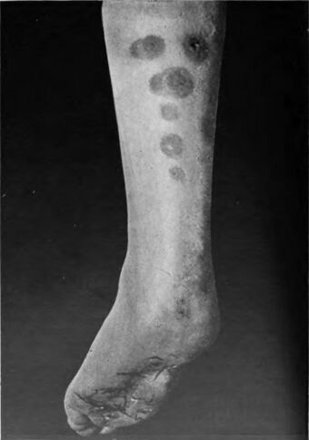An introduction to dermatology (1905) erythema induratum 2.jpg
