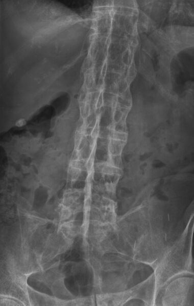 File:Bamboo spine ankylosing spondylitis.jpg