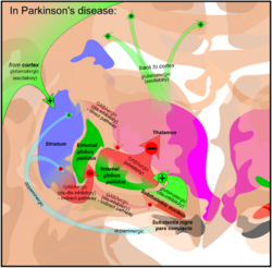 Basal ganglia in Parkinson's disease.png