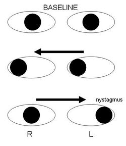 Internuclear ophthalmoplegia.jpg