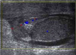 Scrotal ultrasonography of testicular appendiceal torsion.jpg
