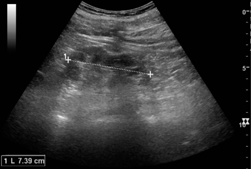 File:Ultrasonography of chronic pyelonephritis with reduced kidney size and focal cortical thinning.jpg