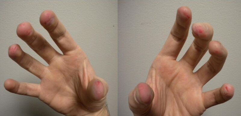 File:Fingers-dermatillomania.jpg