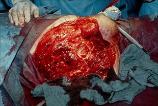 Hemipelvectomy gas gangrene.jpg