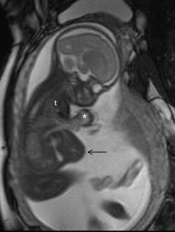 MRI of a fetus with pentalogy of Cantrell.jpg