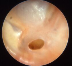 Otitis chron mesotymp 4.jpg