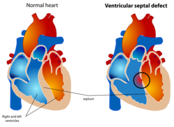 Ventricular septal defect.svg