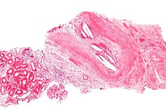 Cholesterol embolus - intermed mag.jpg