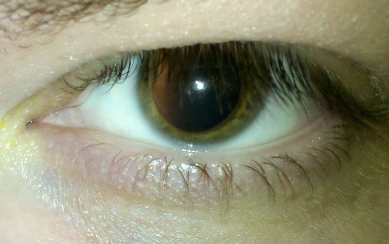 File:Fully dilated eye during eye exam.jpg
