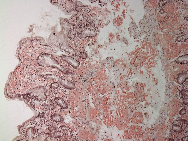 File:Small bowel duodenum with amyloid deposition congo red 10X.jpg