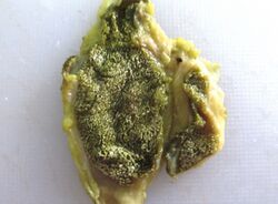 Gross pathology of cholesterolosis.jpg