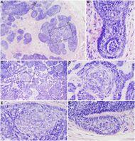 Micrographs of trichoblastoma.jpg