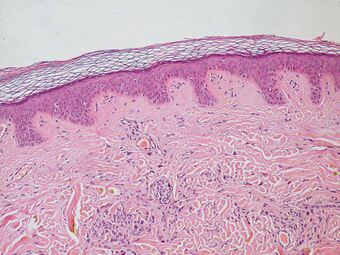 Normal Epidermis and Dermis with Intradermal Nevus 10x.JPG