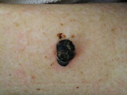 Photography of nodular melanoma.jpg