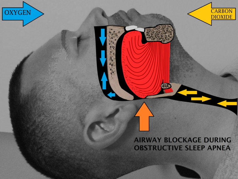 File:Airway obstruction.png