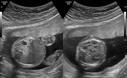 Congenital pulmonary airway malformation in a fetus.jpg