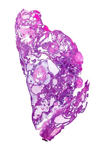 Adamantinomatous craniopharyngioma - very low mag.jpg