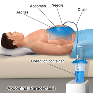 Blausen 0004 AbdominalParacentesis.png