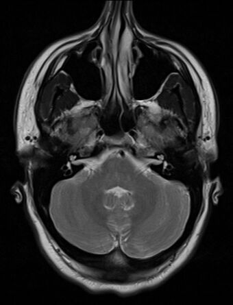 An MRI image showing a congenitally deviated nasal septum
