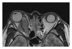 Right optic disc lesion in IgG4-ROD.jpg