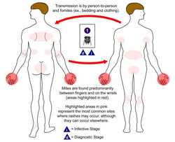 Sites of scabies.png