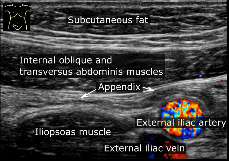 File:Ultrasonography of a normal appendix, annotated.jpg