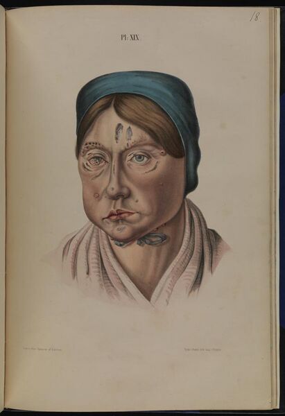 File:A 26 year old woman with leprous lesions Wellcome L0074857.jpg