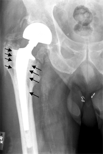 File:Hip joint aseptic loosening ar1938-1.png
