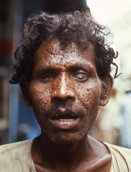 File:Man with facial scarring and blindness due to smallpox, 1972 (cropped).jpg