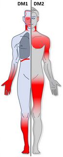 Myotonic dystrophy muscle distribution.jpg