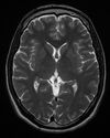 Normal axial T2-weighted MR image of the brain.jpg