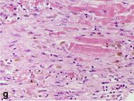 Histopathology of fibroblast proliferation and early collagen deposition in myocardial infarction.jpg