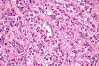 Sertoli cell tumour high mag.jpg