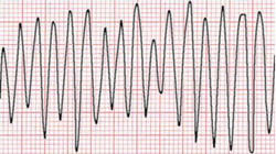 Ventricular Flutter.PNG