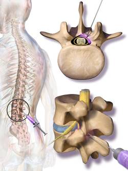 Blausen 0354 EpiduralSteroidInjection.png