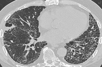 CT scan in usual interstitial pneumonia (UIP).jpg