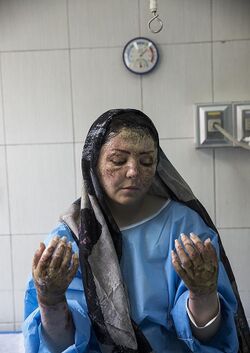 Maryam, an acid-attacked victim under treatment, Tehran - 28 April 2018 20.jpg