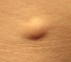 Superficial subcutaneous lipoma.jpg