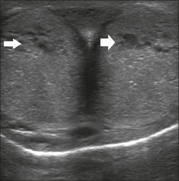 File:Ultrasonography of dilated penile sinusoids during erection.jpg