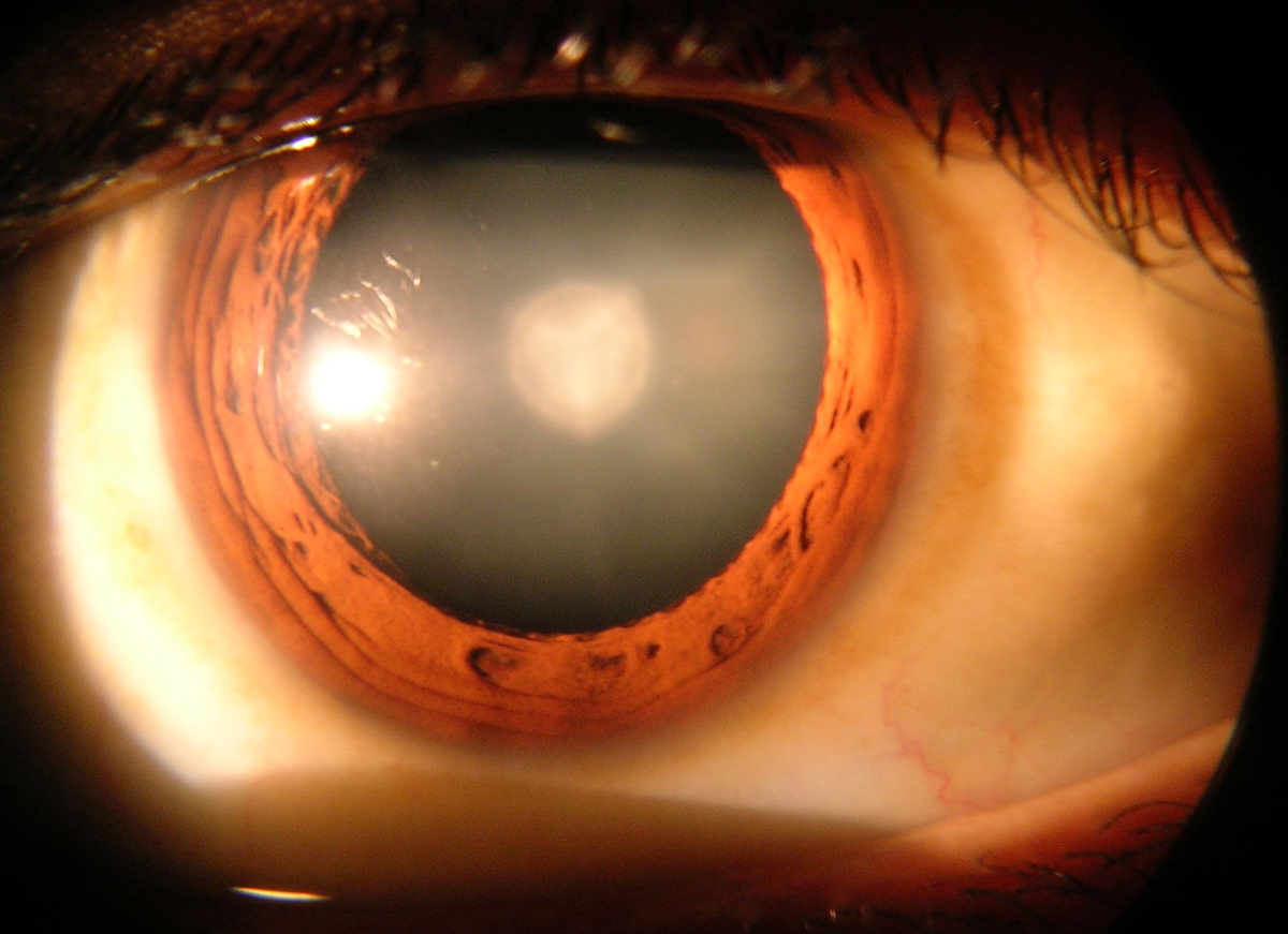 medicine-anterior-segment-of-eyeball-handwiki