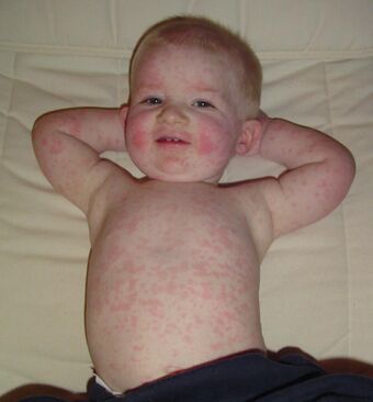 Fifth disease.jpg