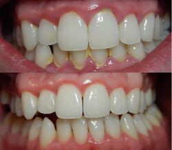 Gingivitis-before-and-after-3.jpg
