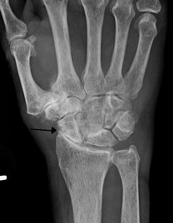 Osteo of the hand.jpg