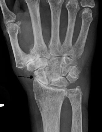 Osteo of the hand.jpg