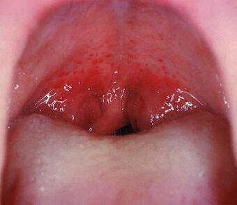 Streptococcal pharyngitis.jpg