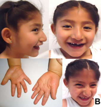 5-year-old Mexican girl with Angelman syndrome (cropped).png