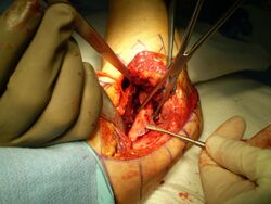 Heterotopic Ossification removal 2011.jpg